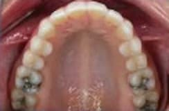 Example photo: upper teeth