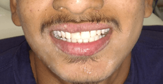 After cosmetic dentistry: Chipped front tooth restored in a single day.