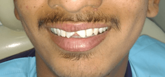 Before cosmetic dentistry at Balaji Dental Clinic, Solapur