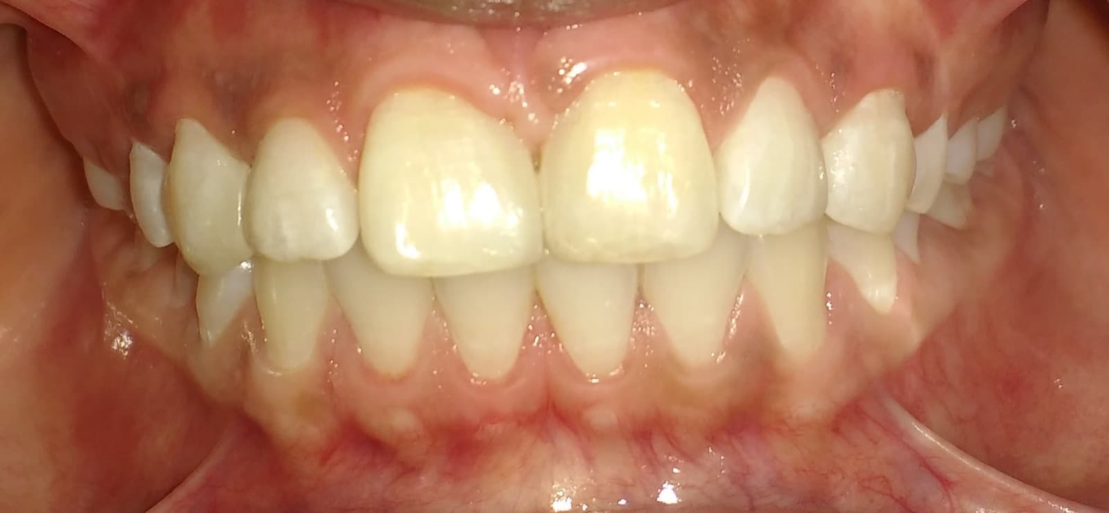 After cosmetic dentistry: Gap between the front teeth closed.