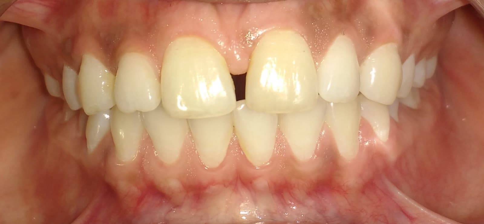 Before cosmetic dentistry at Balaji Dental Clinic, Solapur